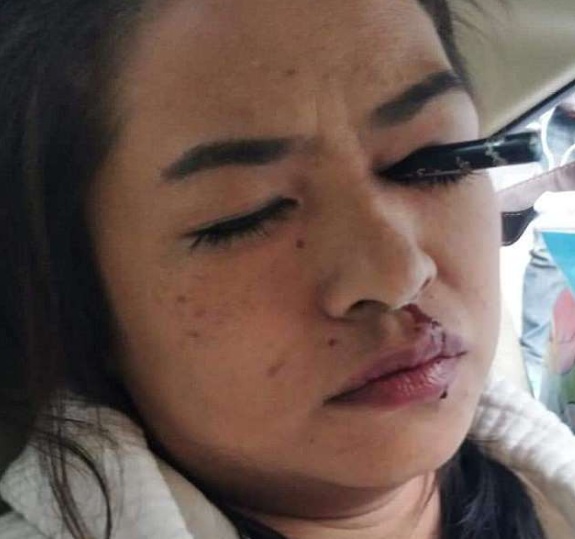 Em acidente de táxi, jovem acaba com lápis de maquiagem preso no olho
