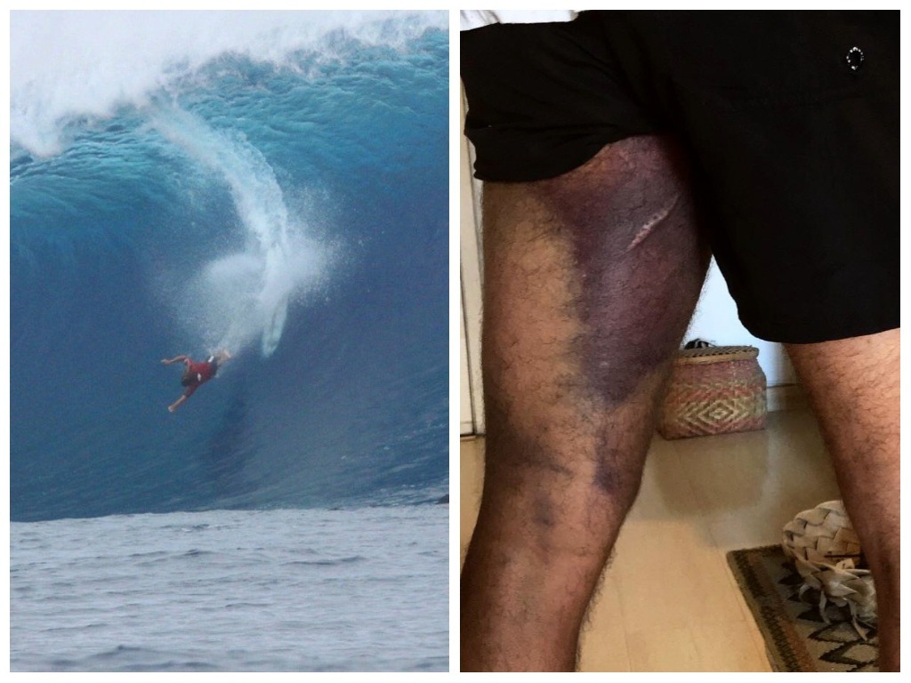 Após acidente em Fiji, surfista Caio Vaz rompe músculo da coxa e fratura ombro