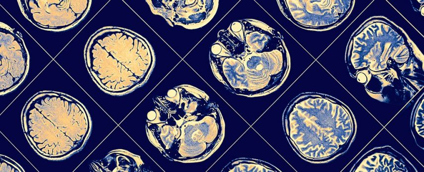 Cientistas descobrem que alguns podem ser imunes ao Alzheimer