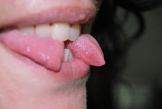 Tendência de cortar a língua ao meio preocupa médicos