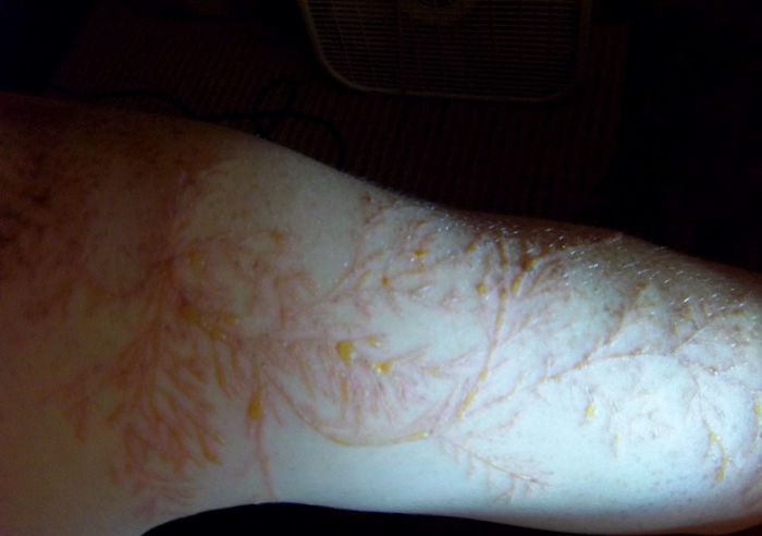 Sobreviventes mostram o que raios fazem com a pele