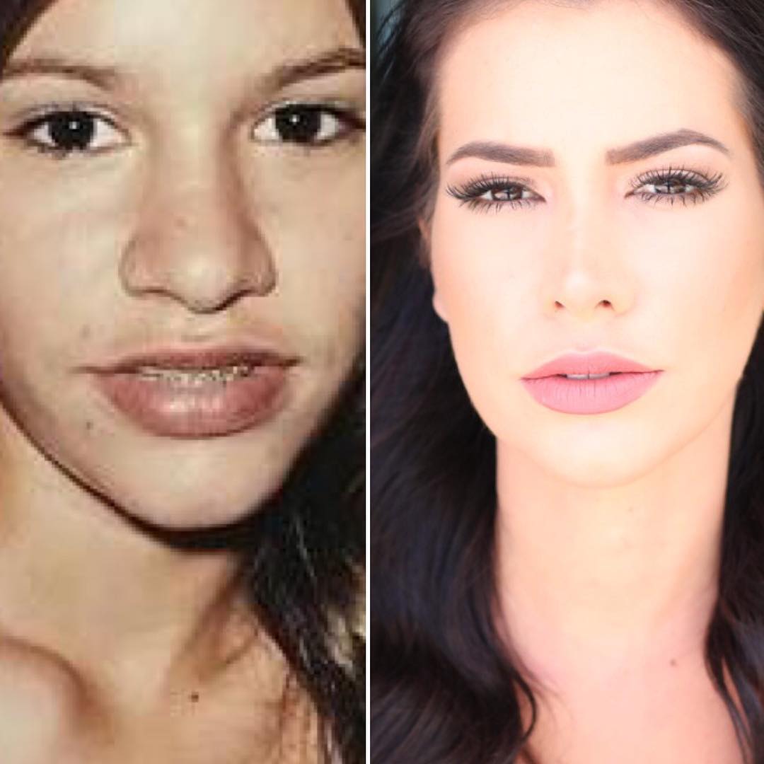 Ex-BBB Adriana faz antes e depois de cirurgias no nariz: "Tenha esperança"