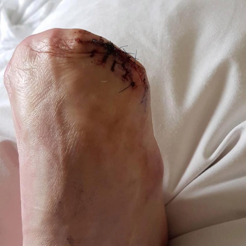 Mulher perde dedos do pé após pedicure com peixes