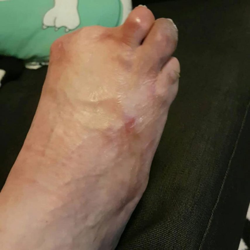 Mulher perde dedos do pé após pedicure com peixes
