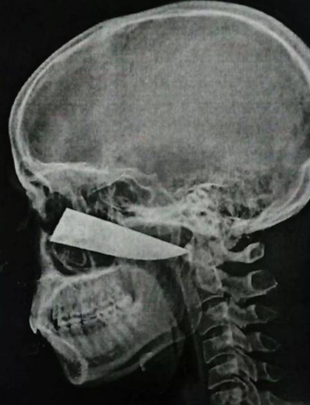 Bêbado leva facada na cabeça e só percebe no raio-X