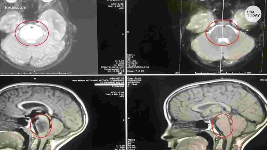 Tumor raro em menina desaparece sem explicação