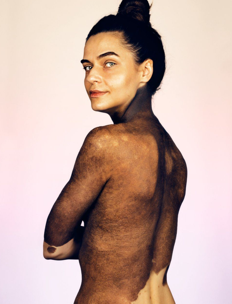 Fotógrafo e ONG reúnem pessoas de 13 países diferentes que sofrem com doença de pele rara
