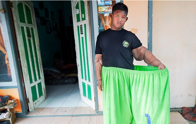 Ele chegou a pesar quase 200 kg aos 10 anos