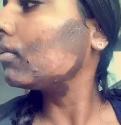 Jovem sofre graves queimaduras após aplicação de laser no rosto