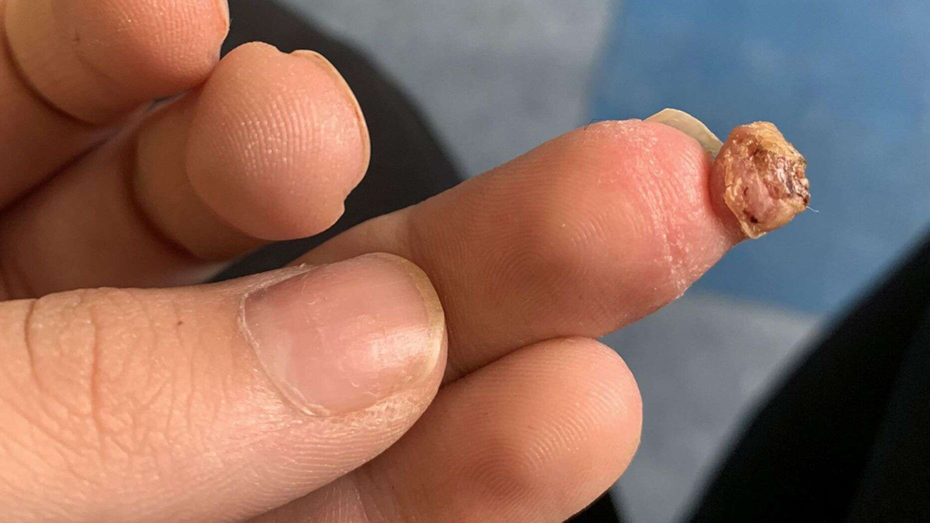 Inglesa quase perde dedo da mão após colocar unhas de acrílico