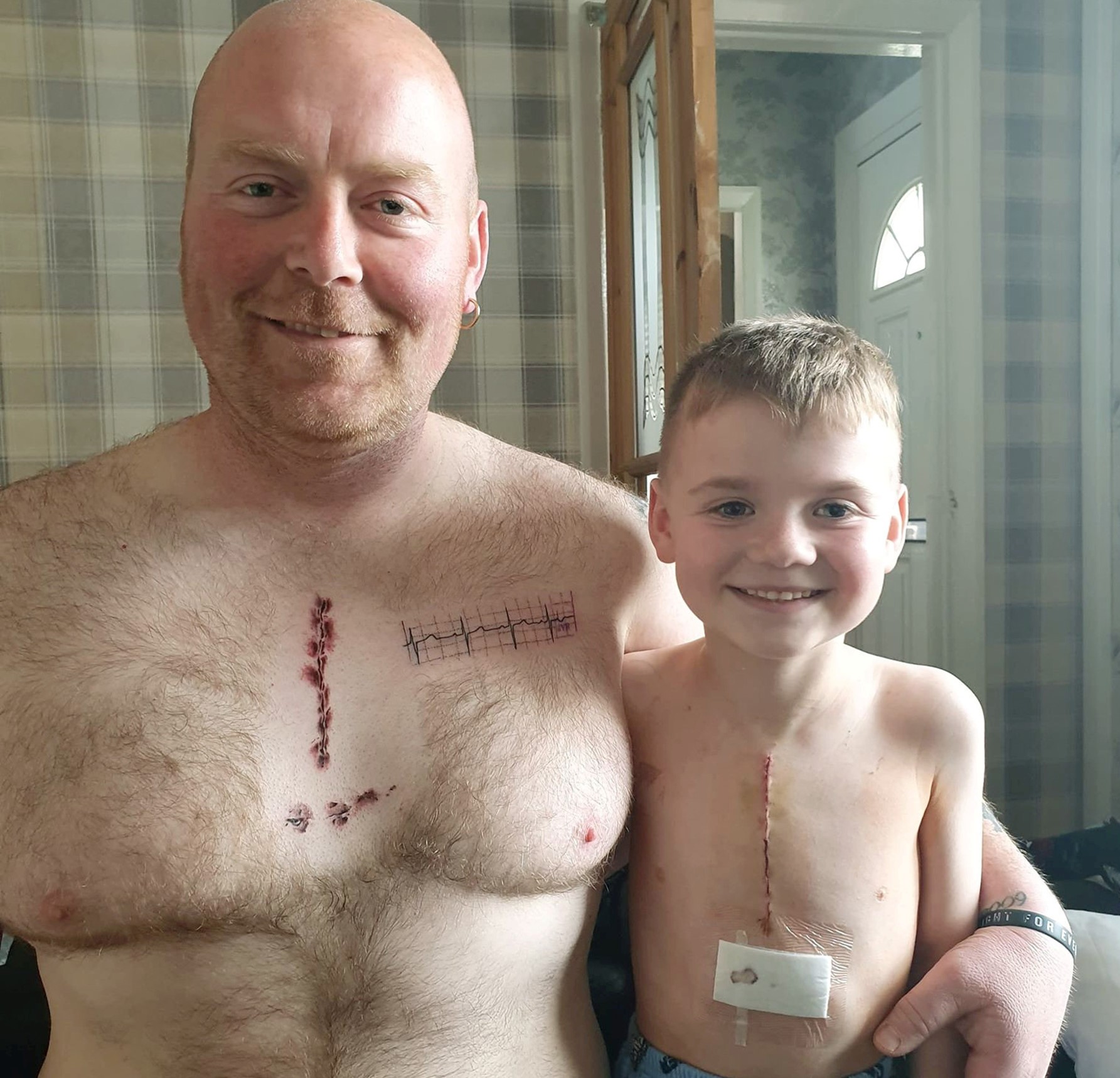 Em gesto emocionante, pai faz tatuagem similar à cicatriz do filho