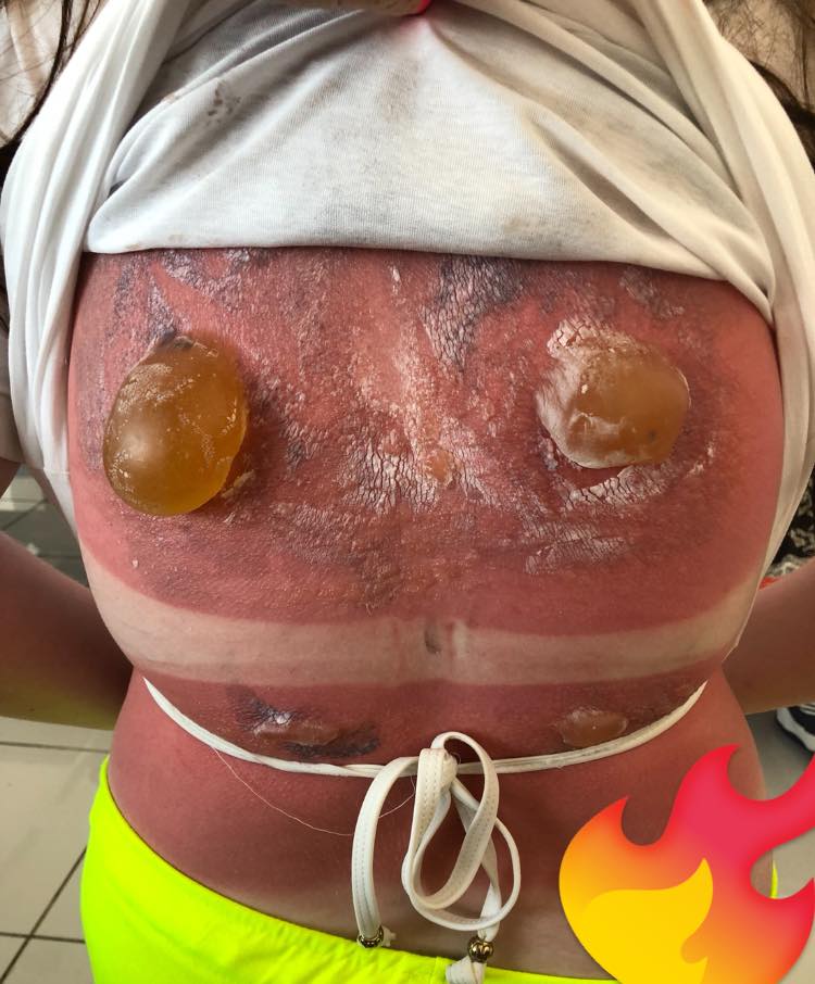 Jovem de 16 anos mostra queimaduras de sol severas e fotos chocam web