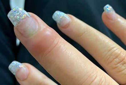 Mulher registra evolução de infecção no dedo