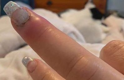 Mulher quase perde o dedo por infecção após manicure