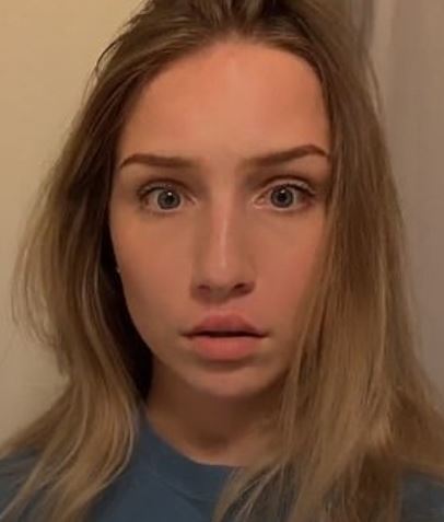 Meninas aderem mania bizarra da internet e usam cola para deixar lábios maiores
