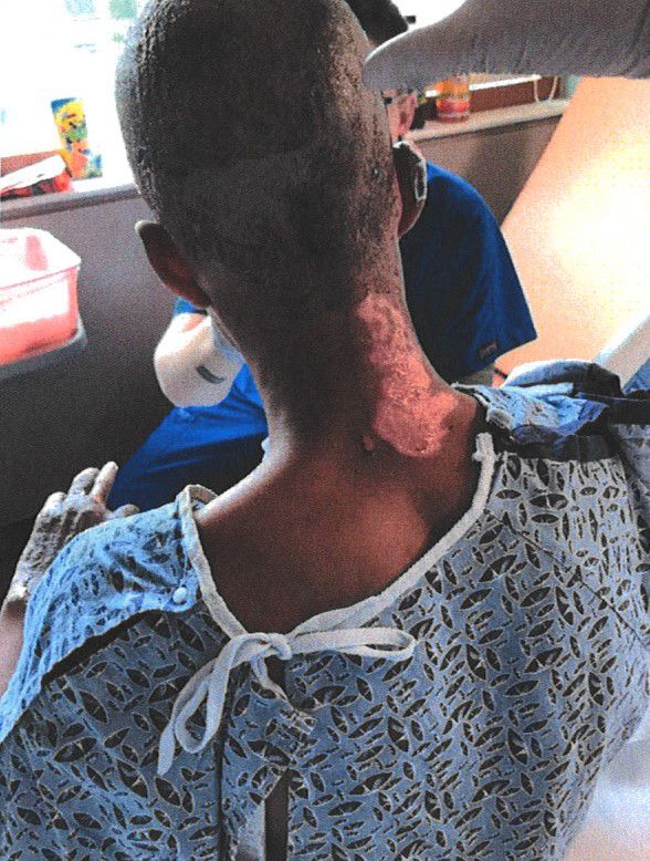 Professora coloca fogo em aluno acidentalmente durante experimento