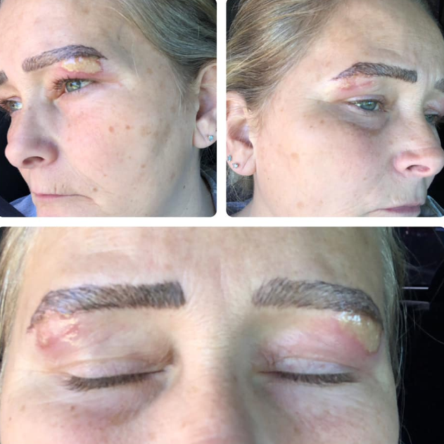 Mulher se revolta com resultado de micropigmentação nas sobrancelhas