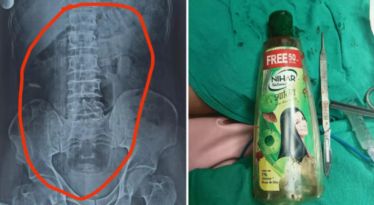 Na Índia, homem engole garrafa plástica e faz cirurgia para remoção
