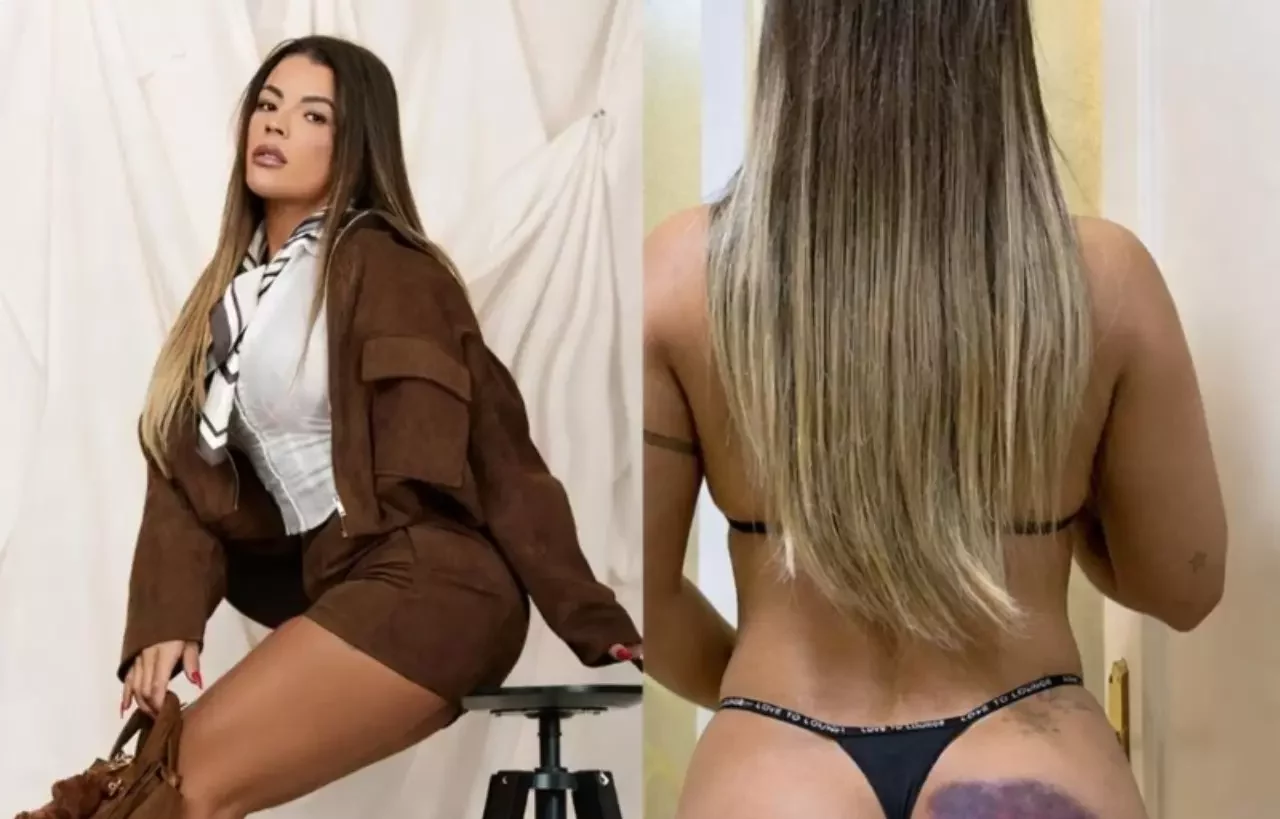 Ex-Miss Bumbum leva tombo em escada e diz que bumbum a salvou de lesão mais grave